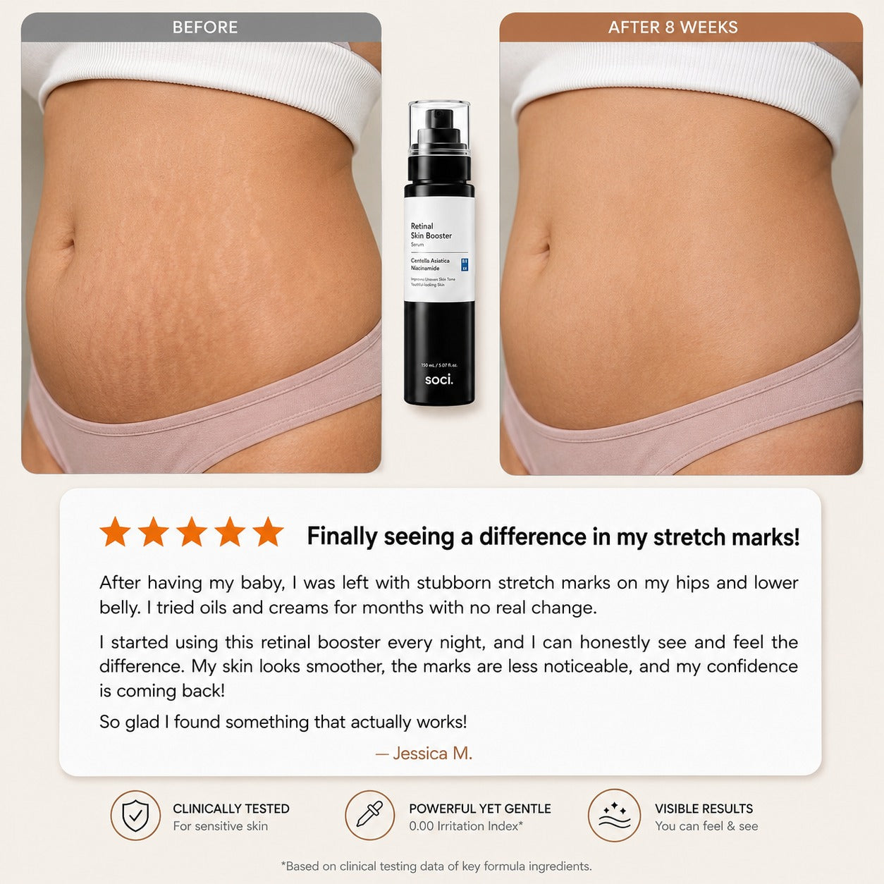 SOCI.™ Advanced Retinal Stretch Mark Serum