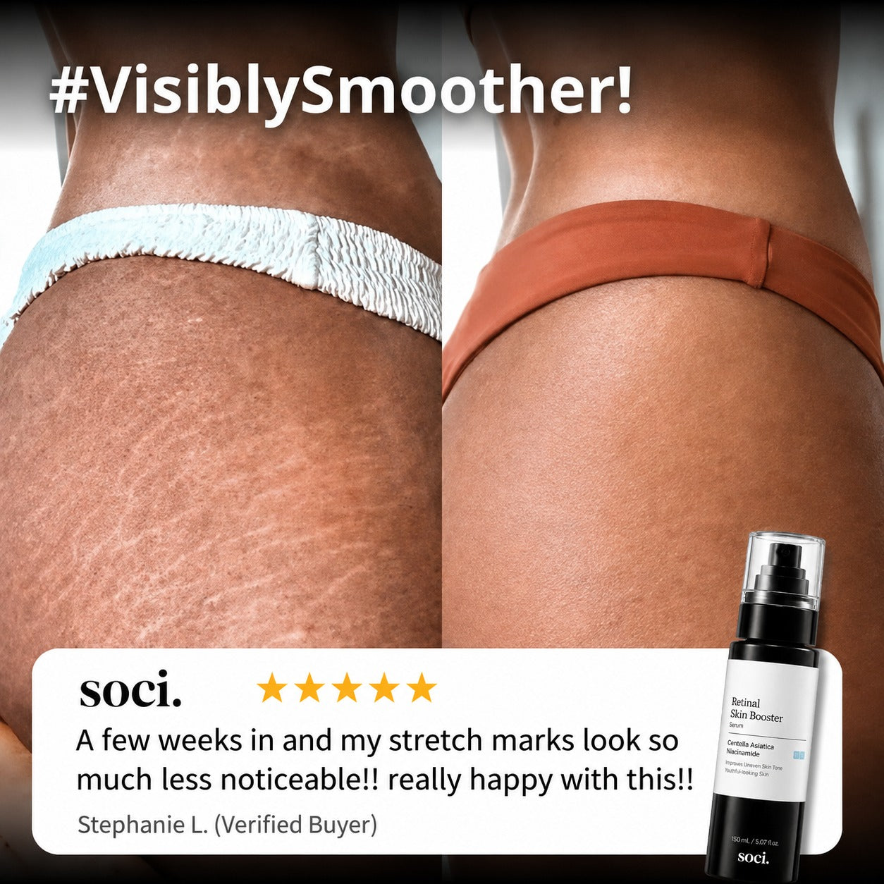 SOCI.™ Advanced Retinal Stretch Mark Serum